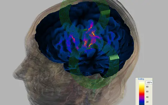 A computer generated model of a brain inside a person's head. 