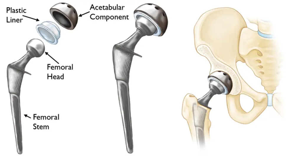 A diagram of a ball attached to a metal stem (left) and its location in a hip replacement (right).
