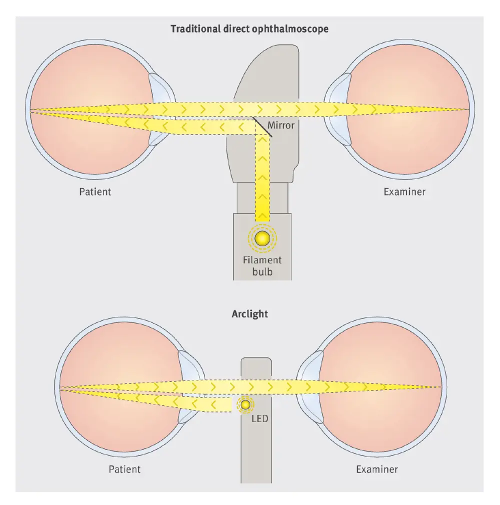 A diagram showing the Arclight LED between the eyes of the patient and the examiner compared to a filament bulb with a mirror on a traditional ophthalmoscope.