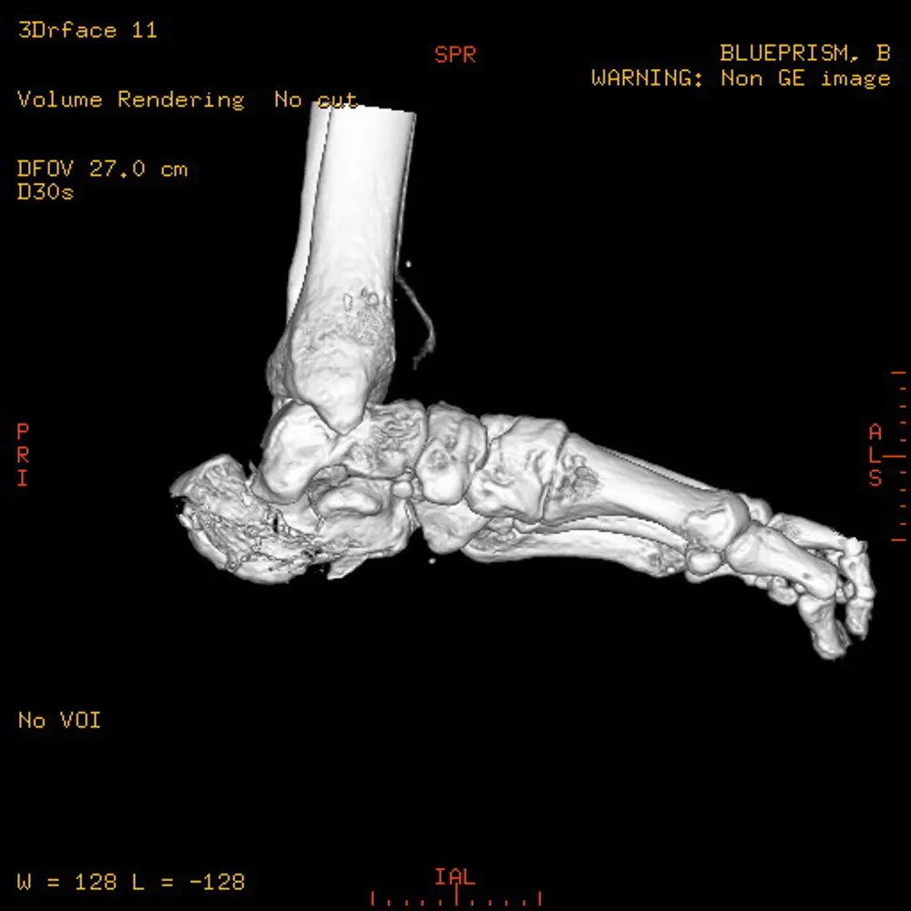 A CT reconstruction of an ankle and foot. 