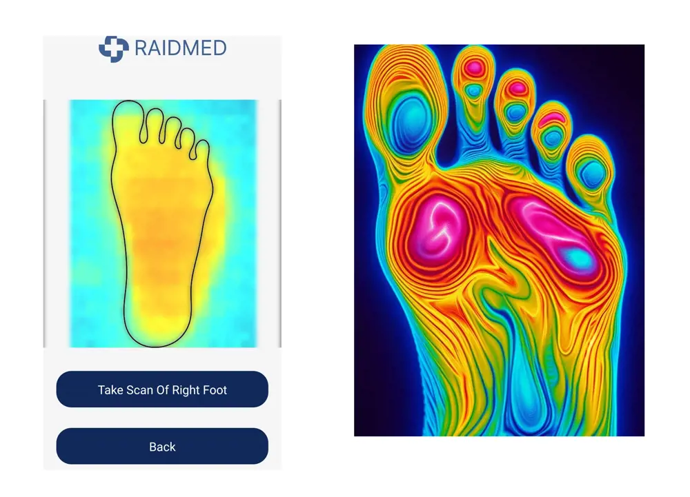 A screenshot of the Raidmed app interface for scanning the right foot (left). A detailed thermal map of a right foot (right).