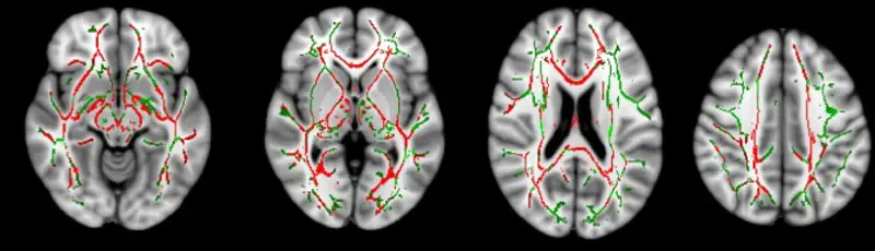 Four greyscale scans of a brain, with different water molecule diffusion lines marked on them. 