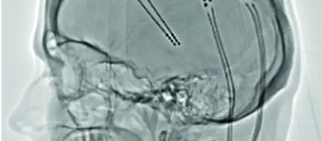 A side-profile X-ray of a head, where wires which are post-operative electrodes have been inserted into the brain.