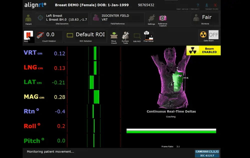 The user interface of AlignRT of a female who is undergoing radiotherapy on their left breast.