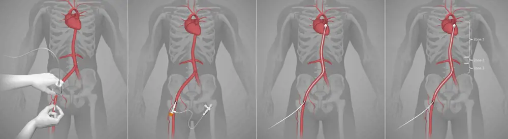 A sequence of four diagrams showing the insertion of the catheter, and the threading into the vein of the REBOA balloon.