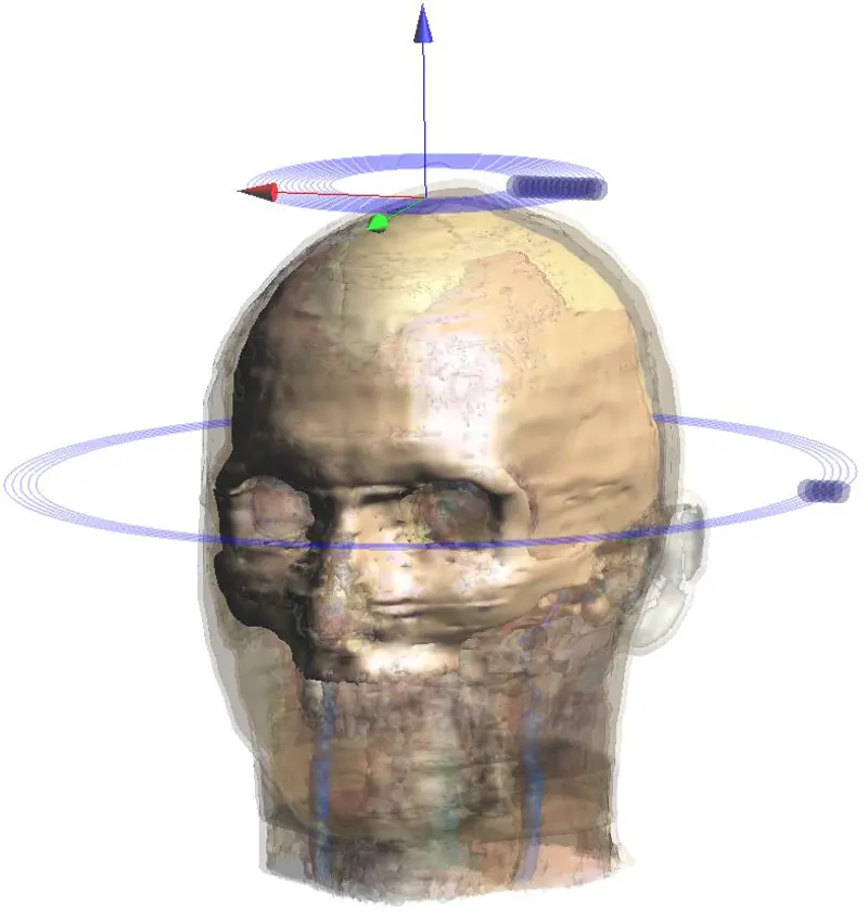 A computer generated image of a skull with a halo coil shown around the middle of the head and a standard circular coil above the head.