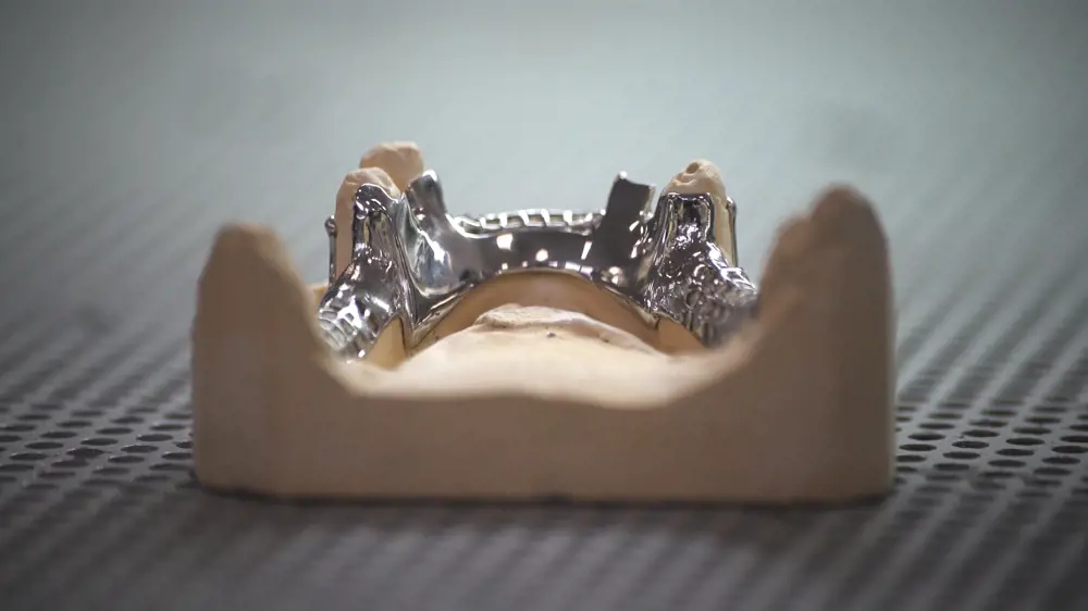 A 3D model of the upper roof of a human's mouth, with metal dental insides inside the mouth.