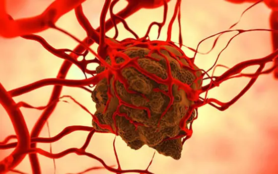 An illustration of a tumour attached to blood vessels. 