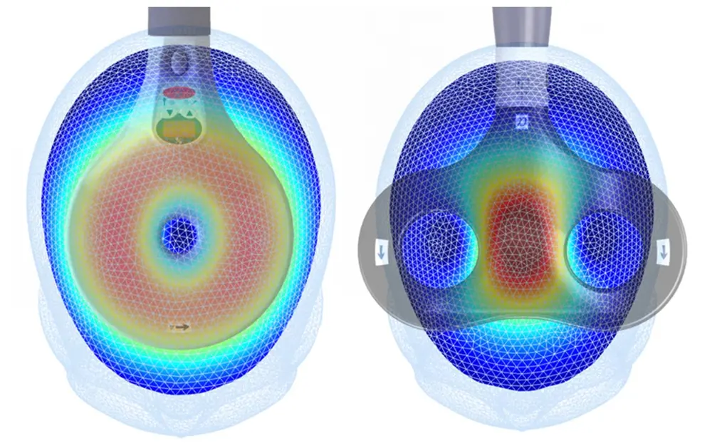 A computer generated image of two induced electric field patterns of a head.