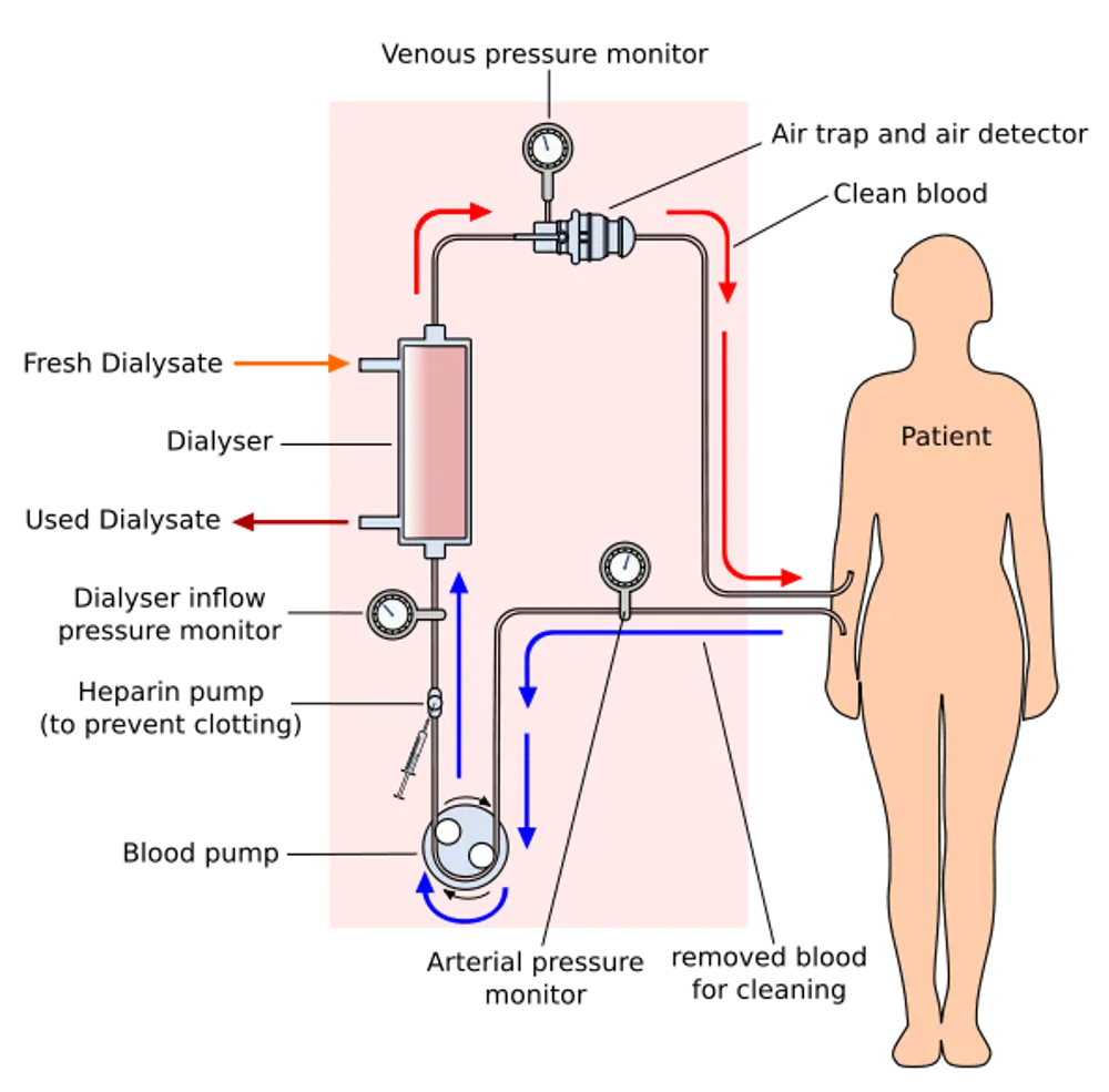 A diagram of a patient connected to a haemodialysis system.