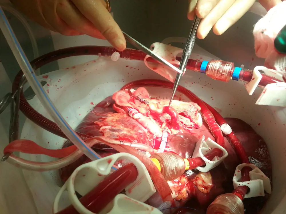 A donated liver in a plastic container being supplied with blood on the OrganOx metra during a surgical procedure.