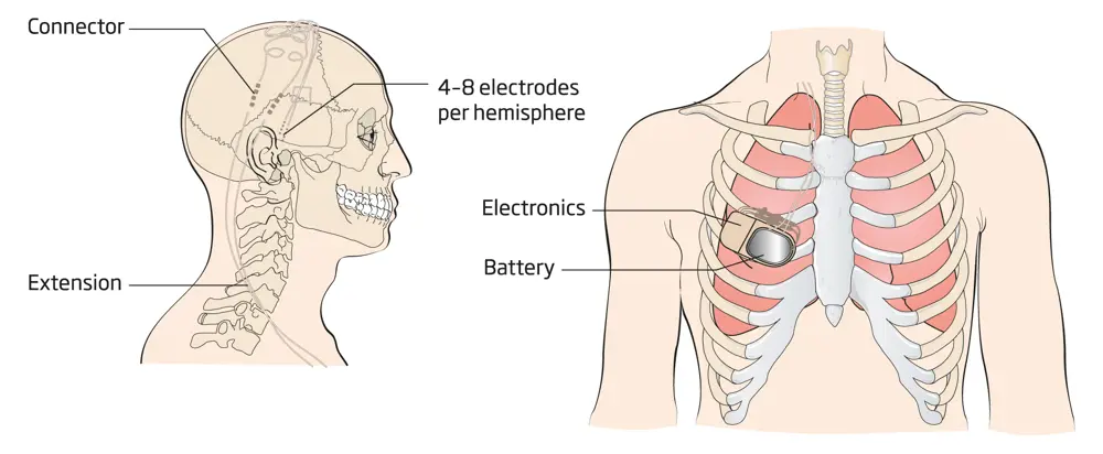 A figure showing the placement of 4-8 electrodes per brain hemisphere and connector for a brain pacemaker system (left) and the implanted battery and circuit on the chest (right).