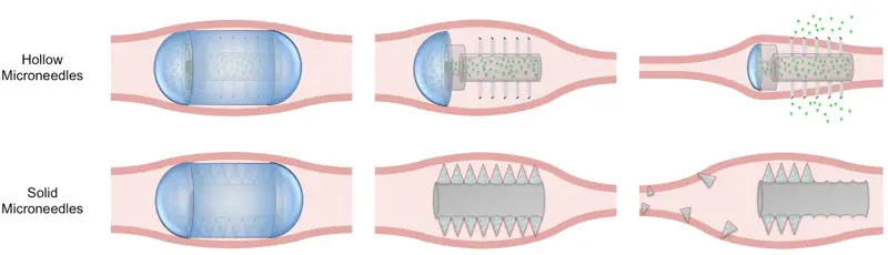 An illustration showing the difference between hollow microneedles (above) and solid microneedles (below).