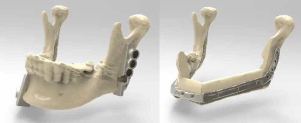 The bottom of a human jaw bone with teeth containing a metal guide attached to the bone on each side of the jaw (left). The bottom of a human jaw bone containing a titanium plate wrapped around it.